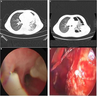 Successful treatment of pleural empyema and necrotizing pneumonia caused by methicillin-resistant Staphylococcus aureus infection following influenza A virus infection: A case report and literature review